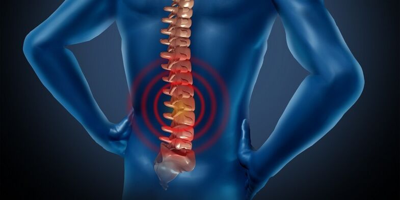 Osteochondrose der Lumbalregion