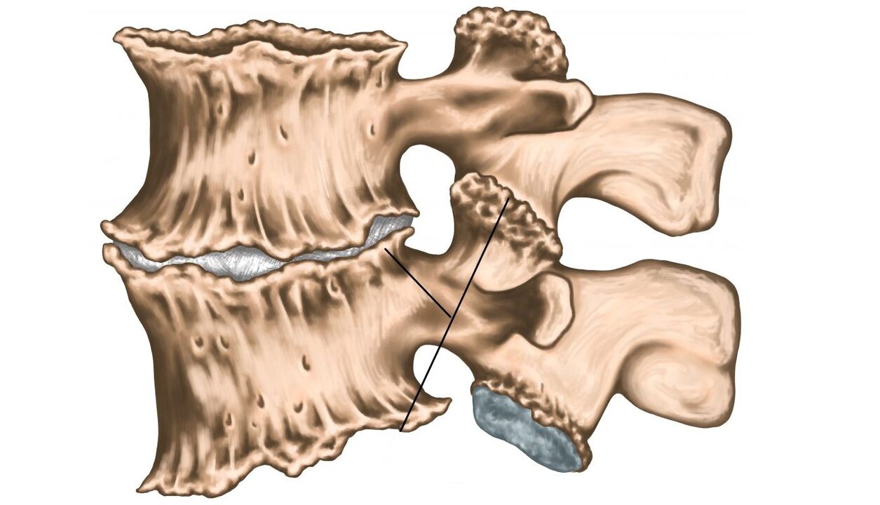 Wirbelsäulenverletzungen aufgrund von Osteochondrose.