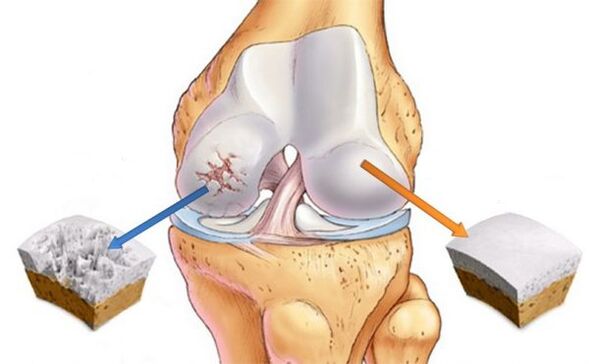 Arthrose des Kniegelenks (links) und normaler Knorpel (rechts)
