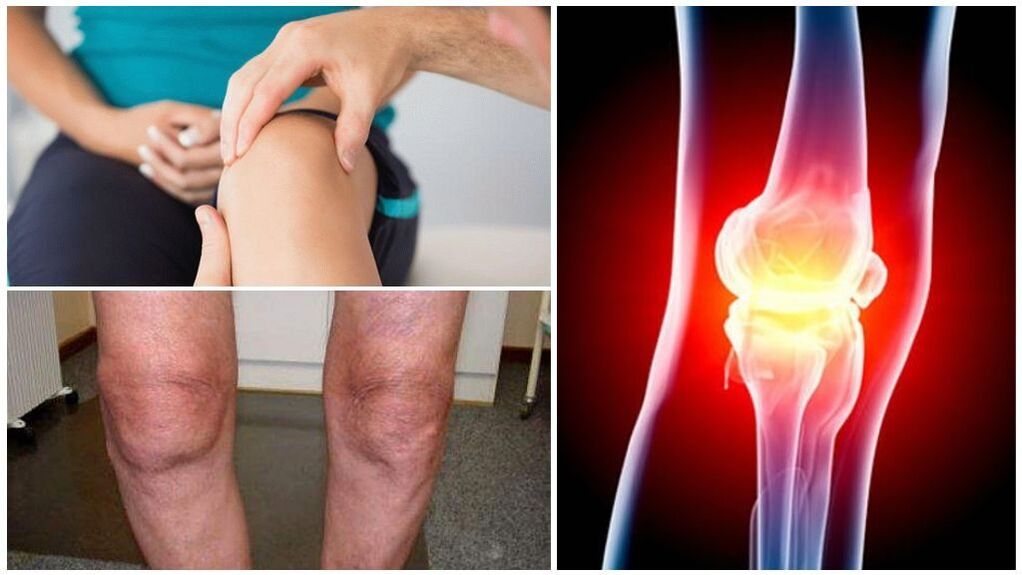 Symptome einer Arthrose des Kniegelenks.