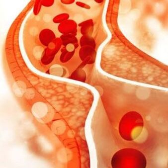 Cholesterinablagerungen an den Innenwänden der Blutgefäße verursachen Schmerzen im Nackenbereich.
